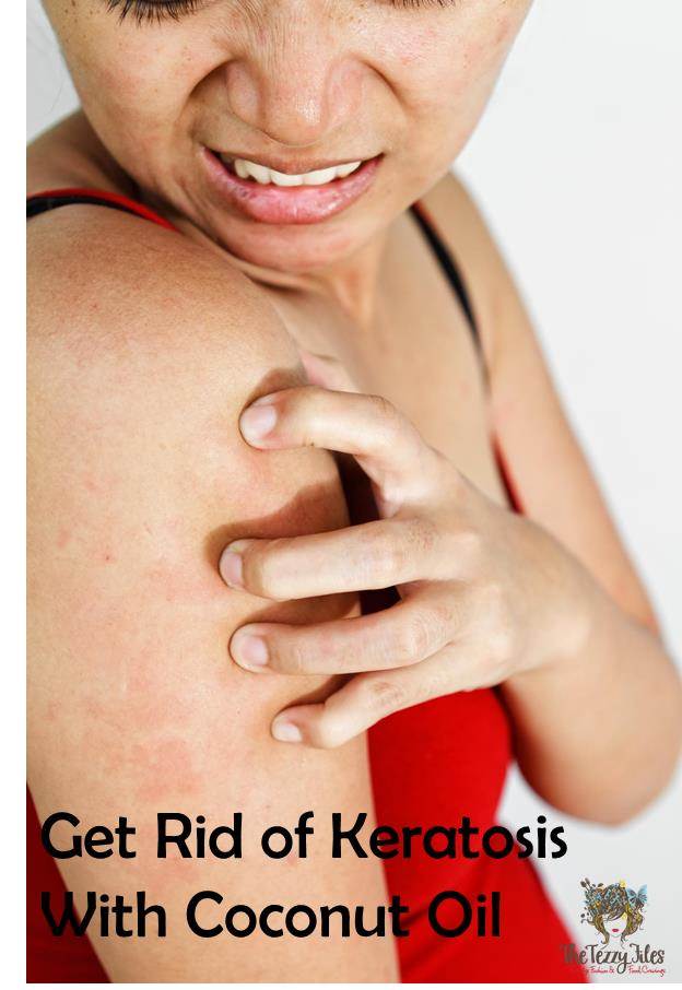 coconut oil for keratosis get rid of red spots on upper arms